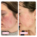 Mariann med rosacea