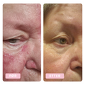 Solbjørg, rosacea